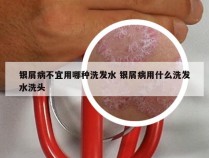 银屑病不宜用哪种洗发水 银屑病用什么洗发水洗头