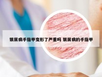 银屑病手指甲变形了严重吗 银屑病的手指甲