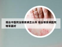 烟台中医院治银屑病怎么样 烟台银屑病医院哪家最好