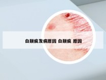 白颠疯发病原因 白颠疯 原因