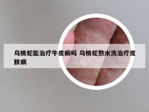 乌梢蛇能治疗牛皮癣吗 乌梢蛇熬水洗治疗皮肤病