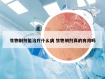 生物制剂能治疗什么病 生物制剂真的有用吗