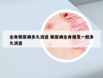 全身银屑病多久消退 银屑病全身爆发一般多久消退