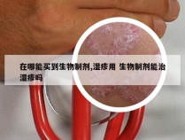 在哪能买到生物制剂,湿疹用 生物制剂能治湿疹吗