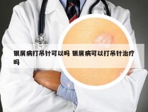 银屑病打吊针可以吗 银屑病可以打吊针治疗吗