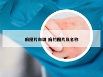 癣图片白斑 癣的图片及名称