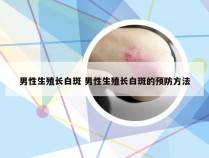 男性生殖长白斑 男性生殖长白斑的预防方法