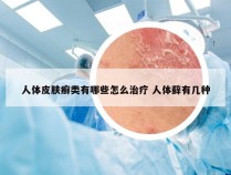 人体皮肤癣类有哪些怎么治疗 人体藓有几种