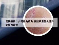 皮肤癣用什么提升免疫力 皮肤癣用什么提升免疫力最好