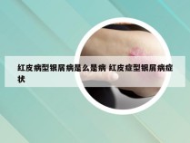 红皮病型银屑病是么是病 红皮症型银屑病症状