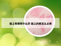 腿上有癣擦什么药 腿上的癣怎么止痒