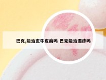 巴克,能治愈牛皮癣吗 巴克能治湿疹吗