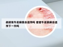 叔叔有牛皮癣我会遗传吗 爸爸牛皮肤癣会遗传下一代吗