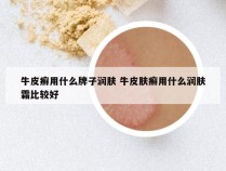 牛皮癣用什么牌子润肤 牛皮肤癣用什么润肤霜比较好