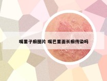 嘴里子癣图片 嘴巴里面长癣传染吗