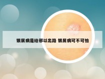 银屑病是给邪以出路 银屑病可不可怕