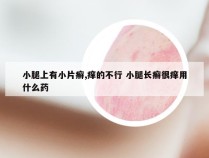 小腿上有小片癣,痒的不行 小腿长癣很痒用什么药