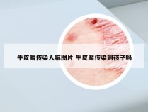 牛皮廨传染人嘛图片 牛皮廨传染到孩子吗