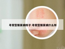 寻常型银屑病样子 寻常型银屑病什么样