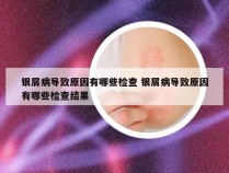 银屑病导致原因有哪些检查 银屑病导致原因有哪些检查结果