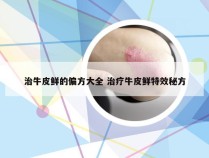 治牛皮鲜的偏方大全 治疗牛皮鲜特效秘方