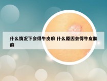 什么情况下会得牛皮癣 什么原因会得牛皮肤癣