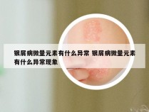 银屑病微量元素有什么异常 银屑病微量元素有什么异常现象