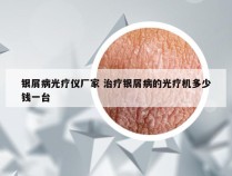 银屑病光疗仪厂家 治疗银屑病的光疗机多少钱一台