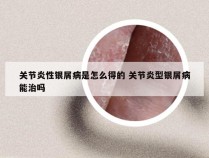 关节炎性银屑病是怎么得的 关节炎型银屑病能治吗