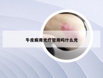 牛皮癣用光疗管用吗什么光