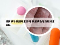 银屑病导致胆红素高吗 银屑病会导致胆红素高吗