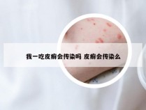 我一吃皮癣会传染吗 皮癣会传染么