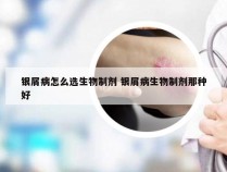 银屑病怎么选生物制剂 银屑病生物制剂那种好