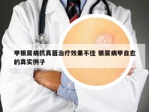 甲银屑病抗真菌治疗效果不佳 银屑病甲自愈的真实例子