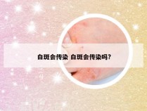 白斑会传染 白斑会传染吗?