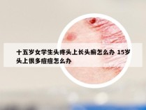 十五岁女学生头疼头上长头癣怎么办 15岁头上很多痘痘怎么办