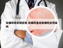 白癞风和白斑区别 白癞风是皮肤病吗会传染吗