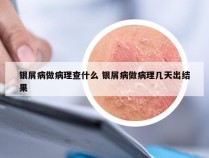 银屑病做病理查什么 银屑病做病理几天出结果