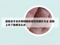 屁股会不会长铜钱癣的症状及图片大全 屁股上长了股癣怎么办