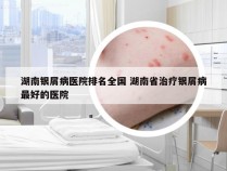 湖南银屑病医院排名全国 湖南省治疗银屑病最好的医院