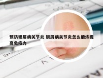 预防银屑病关节炎 银屑病关节炎怎么锻炼提高免疫力