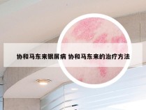 协和马东来银屑病 协和马东来的治疗方法