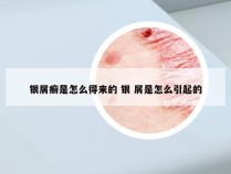 银屑癣是怎么得来的 银 屑是怎么引起的