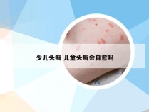 少儿头癣 儿童头癣会自愈吗