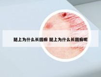 腿上为什么长圆癣 腿上为什么长圆癣呢