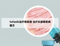 tofanib治疗银屑病 治疗头部银屑病偏方