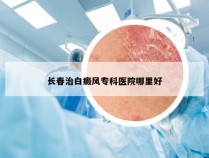 长春治白癜风专科医院哪里好