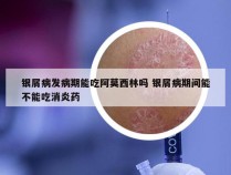 银屑病发病期能吃阿莫西林吗 银屑病期间能不能吃消炎药