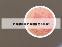 白藓病图片 白藓病是怎么回事?