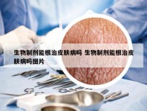 生物制剂能根治皮肤病吗 生物制剂能根治皮肤病吗图片